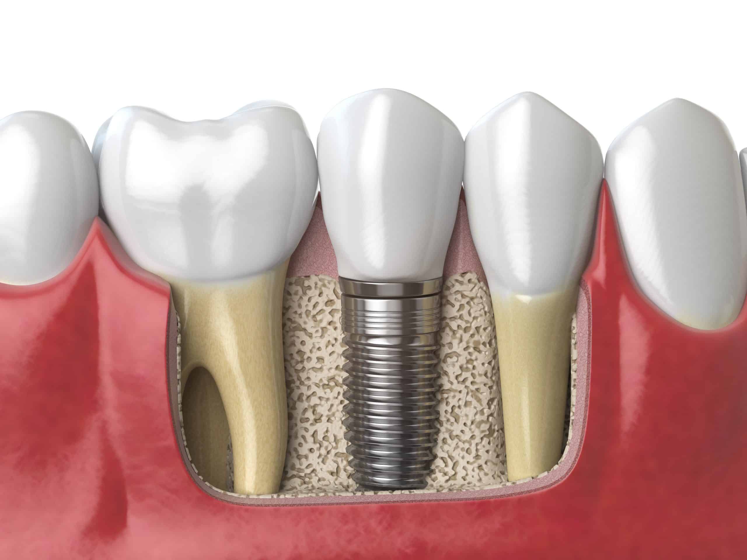 Implant1