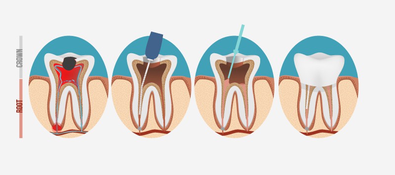 Root-Canal Root canal dentist