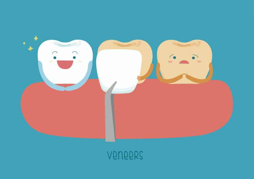 Veneers Dental veneers
